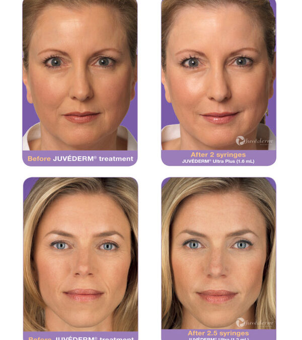 juvederm-before-after