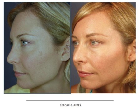 Customized Clinical Couture Chemical Peel