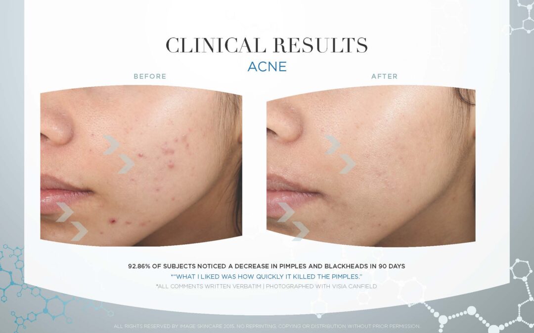 Acne Clinical Results