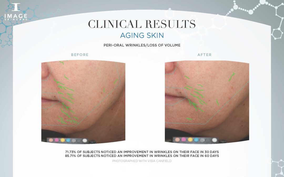 Aging Skin Clinical Results Nasolabial Folds