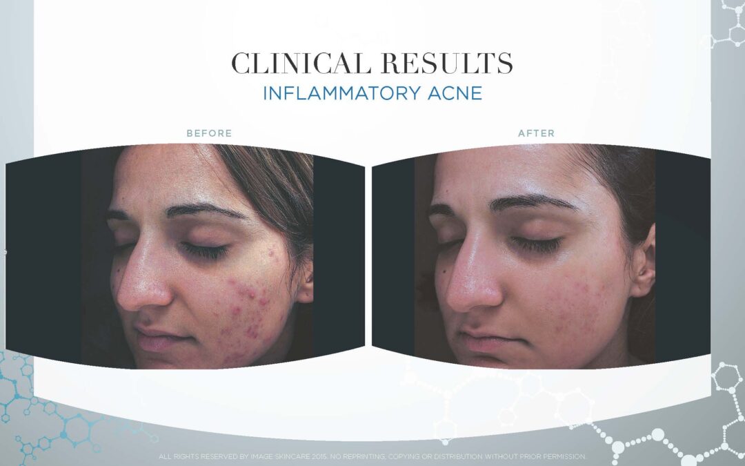 Inflammatory Acne