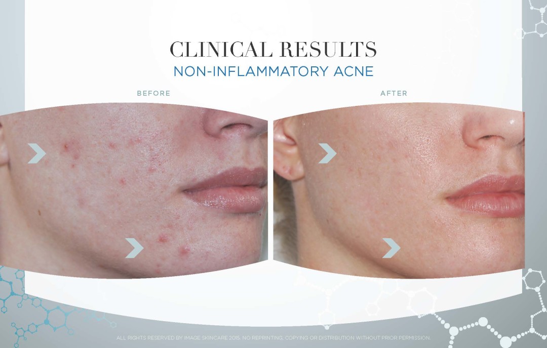 non-inflammatory-acne-mystique-medical-day-spa