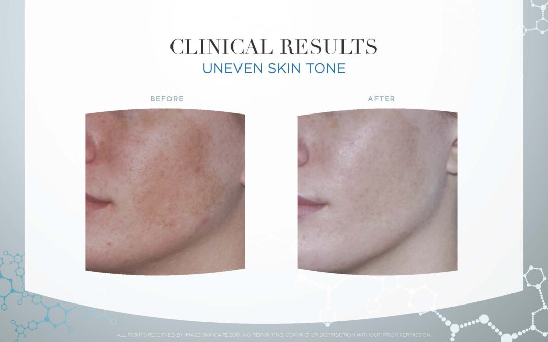 Uneven Skin Tone Results
