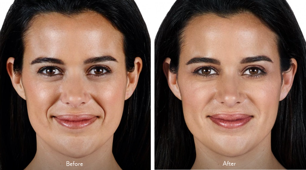Receive a FREE FILLER SYRINGE SET worth $1,550 or more when you purchase a filler package!