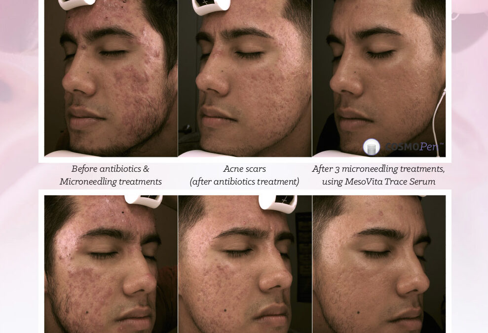 Clinical Results – Acne