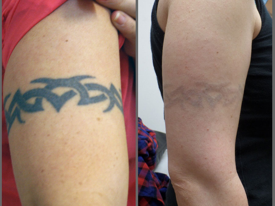 Tattoo Removal Before And After - Mystique Medical Day Spa