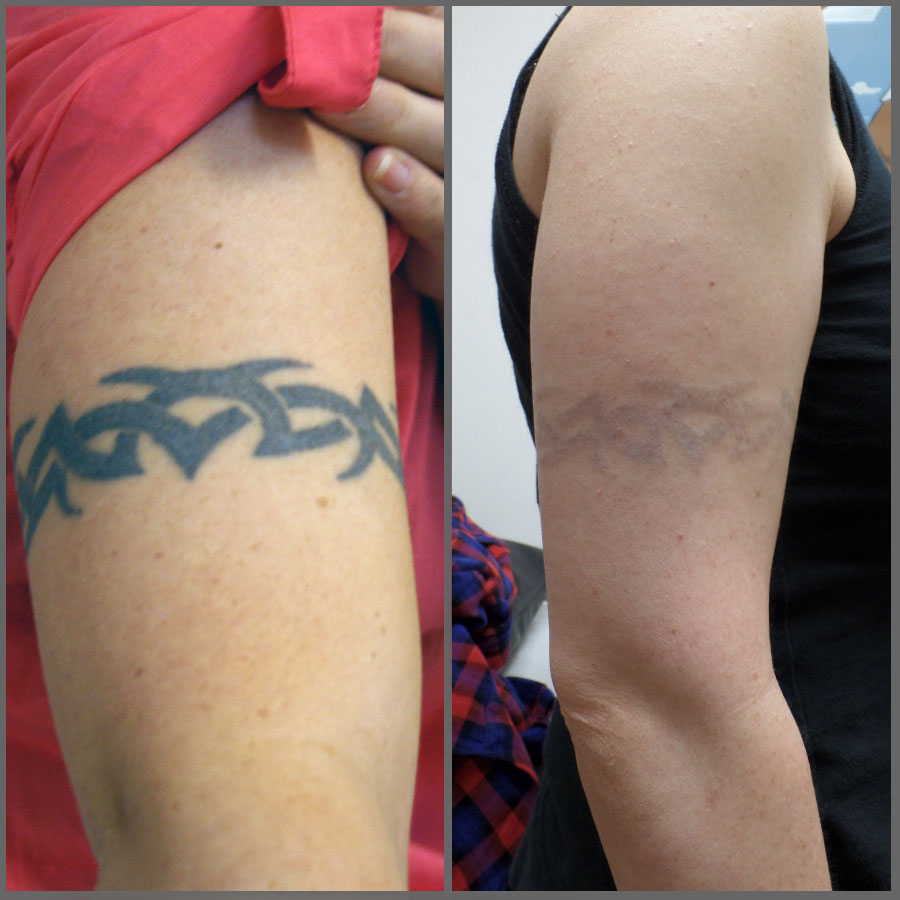 Tattoo removal cost fresno ca