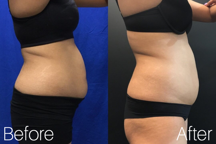 Coolsculpting | Actual Patient | Results May Vary