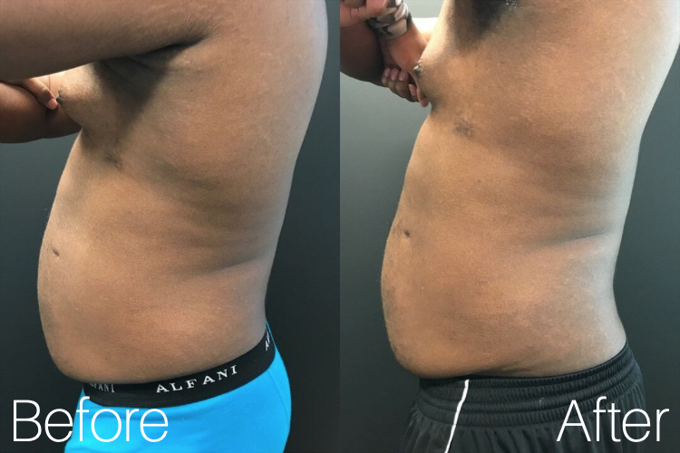 Coolsculpting | Actual Patient | Results May Vary