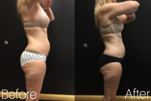 UltraShape Power | Actual Patient | Results may Vary
