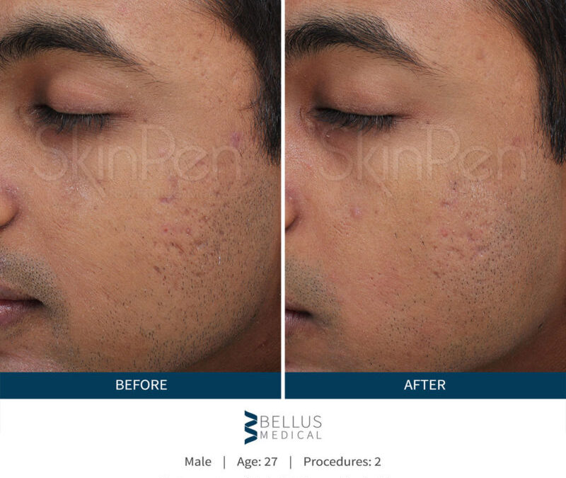 skinpen-male-before-after-1-800×810