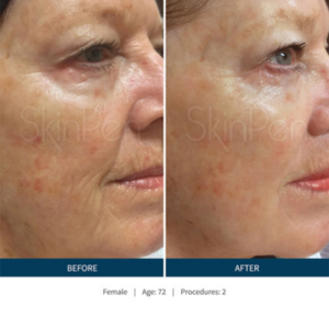 Microneedling with PRP Fresno | Mystique Medical Spa