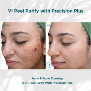 VI Peel Before & After