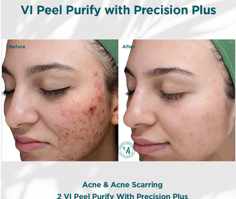 Vi Peel Before And After Mystique Medical Day Spa 3902