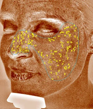 visia analysis brown spots