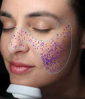 visia analysis pores