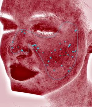 visia analysis red areas