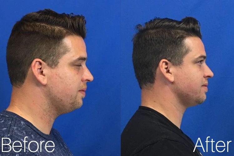 kybella patient results before and after