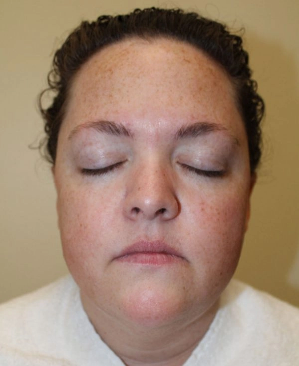 skinpen microneedling patient before