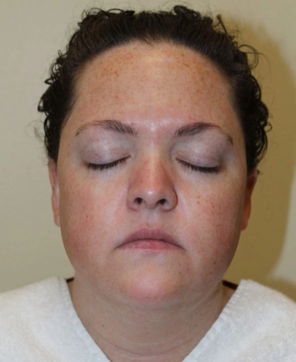 skinpen microneedling patient 24 hours after