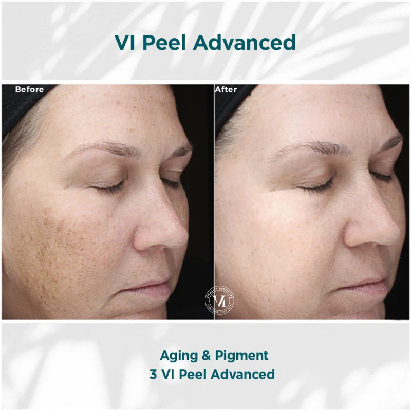 patient results after VI peel