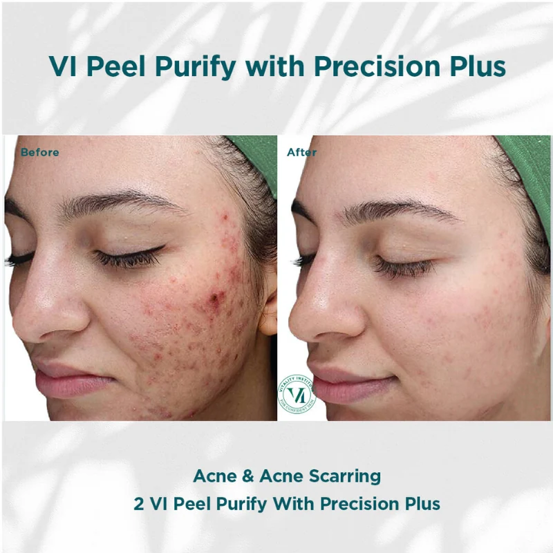 patient results after VI peel