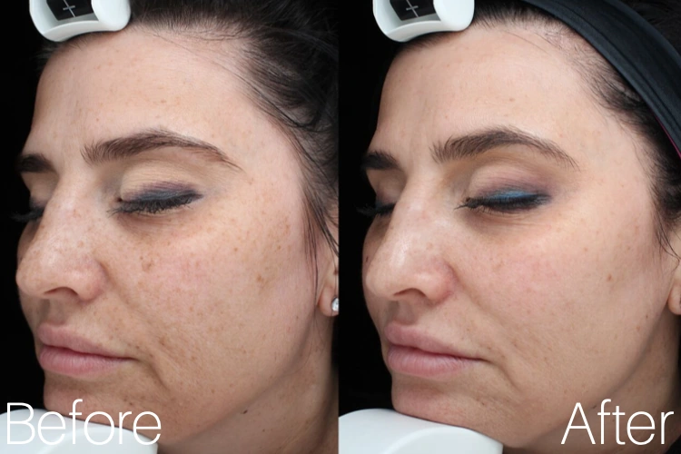 visia skin analysis patient before and after