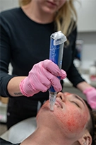 Mystique skinpen microneedling treatment