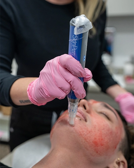 Mystique skinpen microneedling treatment