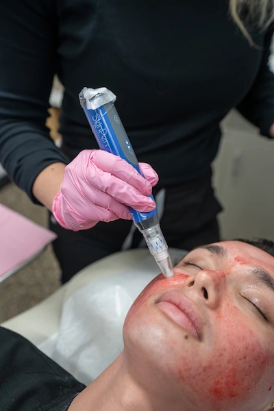 Patient receiving microneedling at Mystique MedSpa
