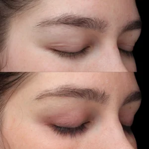 LATISSE Eyelash Therapy before and after