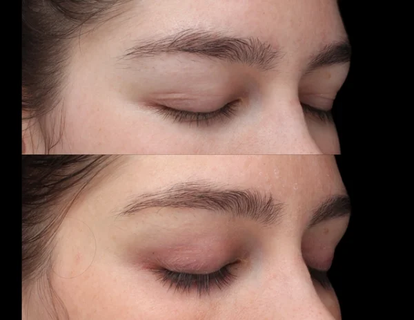 LATISSE Eyelash Therapy before and after