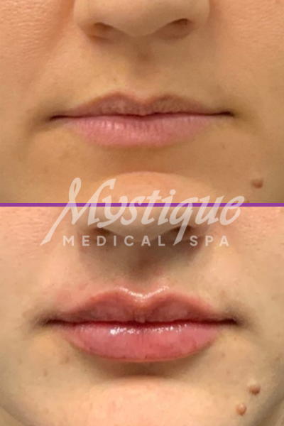 Lip Filler at Mystique Medical Spa