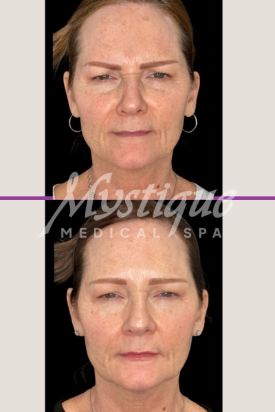 Botox & Filler Treatment