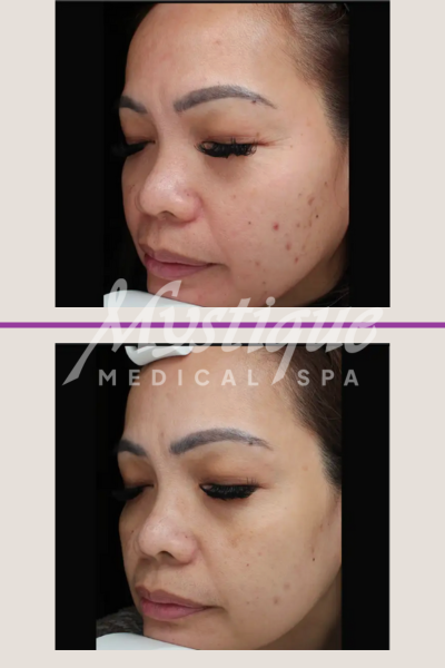 Microneedling Treatment