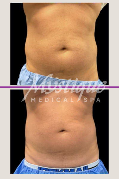 CoolSculpting Elite